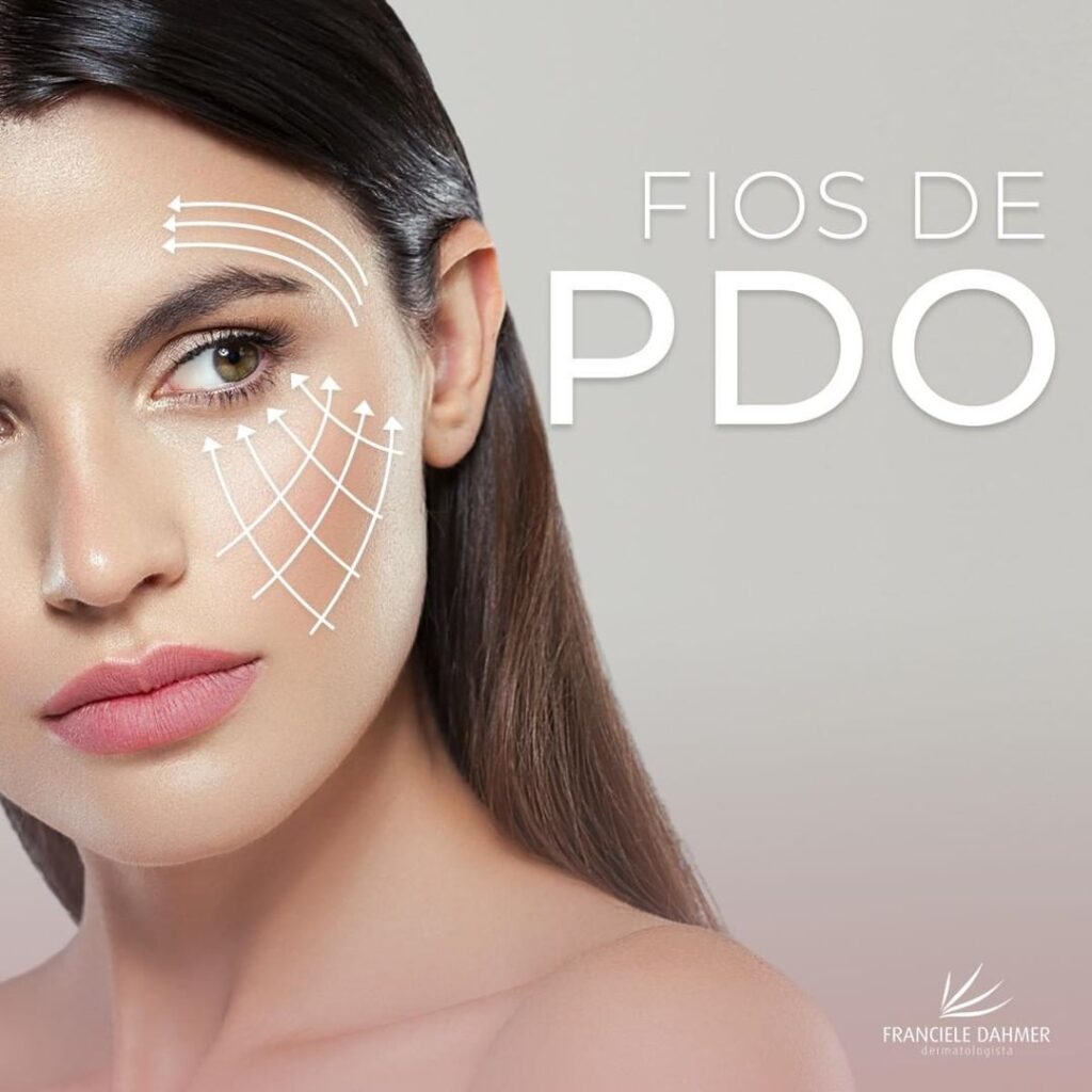 Fios de PDO ( polidioxanona)